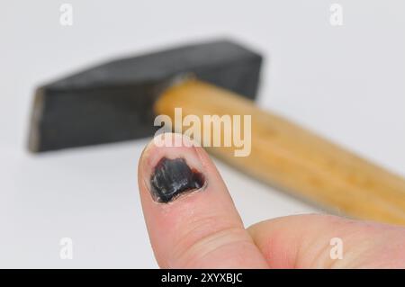 Blauer Fingernagel nach einem falschen Hammerschlag. Frau mit blauem Fingernagel und Hammer Stockfoto