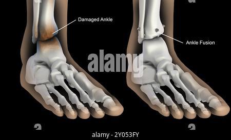 Biomedizinische Darstellung der Knöchelfusion Stockfoto