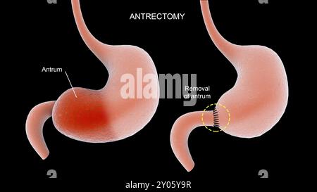 Illustration des Anrektomieverfahrens am menschlichen Magen Stockfoto