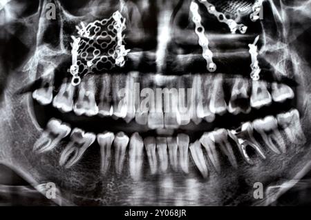 Panorama X Ray zeigt mehrere Platten, Schrauben zur Befestigung des Oberkiefers, Titangewebe auf der rechten Seite, zerfallene UL6, fehlerhafte Wurzel LL6 Stockfoto