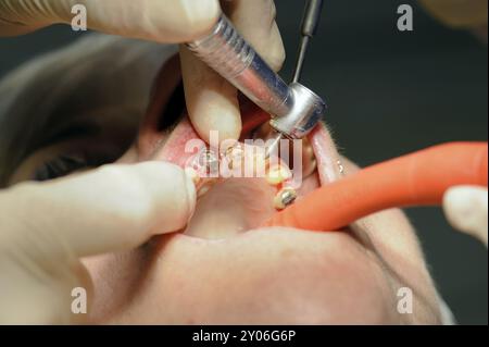 Nahaufnahme einer zahnärztlichen Behandlung Stockfoto