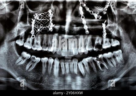 Panorama X Ray zeigt mehrere Platten, Schrauben zur Befestigung des Oberkiefers, Titangewebe auf der rechten Seite, zerfallene UL6, fehlerhafte Wurzel LL6 Stockfoto