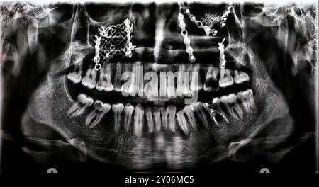 Panorama X Ray zeigt mehrere Platten, Schrauben zur Befestigung des Oberkiefers, Titangewebe auf der rechten Seite, zerfallene UL6, fehlerhafte Wurzel LL6 Stockfoto