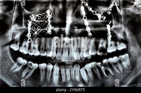 Panorama X Ray zeigt mehrere Platten, Schrauben zur Befestigung des Oberkiefers, Titangewebe auf der rechten Seite, zerfallene UL6, fehlerhafte Wurzel LL6 Stockfoto