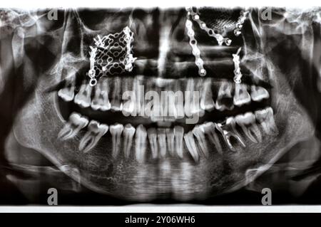 Panorama X Ray zeigt mehrere Platten, Schrauben zur Befestigung des Oberkiefers, Titangewebe auf der rechten Seite, zerfallene UL6, fehlerhafte Wurzel LL6 Stockfoto