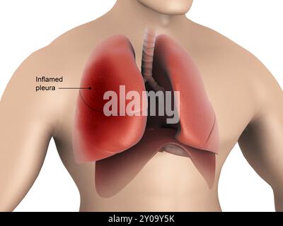 Medizinische Illustration der Pleuritis. Pleuritis ist eine Entzündung der Membranen, die die menschliche Lunge umgeben Stockfoto