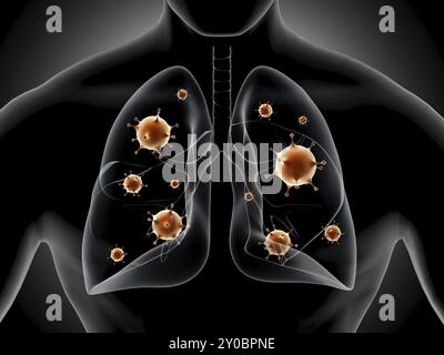 Medizinische Illustration der Pneumonie in der menschlichen Lunge Stockfoto