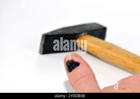 Blauer Fingernagel, nach einem Schlag mit dem Hammer. Blauer Fingernagel, nach einem Schlag mit dem Hammer Stockfoto