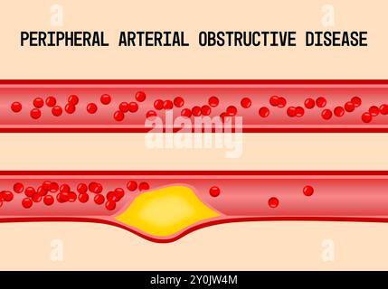 Periphere arterielle Verschlusskrankheit ist die Verengung oder Blockierung einer Arterie in den Beinen, meist aufgrund von Atherosklerose. Medizinische Illustration Stockfoto