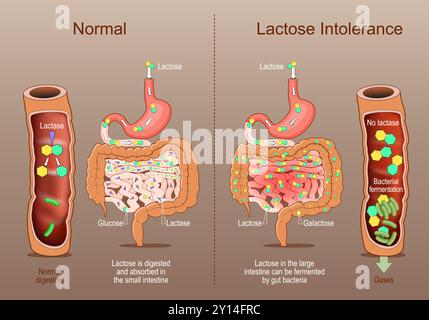 Laktoseintoleranz. Querschnitt eines menschlichen Darms mit Laktase, Glucose, Galaktose. Vergleich der normalen Verdauung bei Laktose-Verdauung Stock Vektor