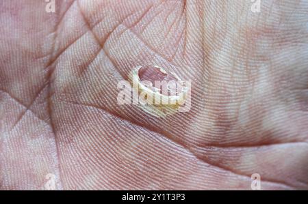 Blase auf der schmutzigen Handfläche von harter Arbeit Stockfoto