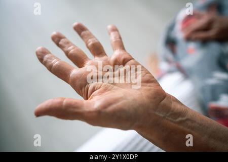 Die Handsehnenerkrankung. Abgeschnittene Frauenhand mit dichtem Knoten unter dem Finger. Dupuytren-Muskelkontraktur Stockfoto