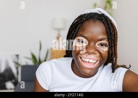 Porträt einer jungen afrikanerin mit Vitiligo, die in der Kamera lächelt und sich auf dem Sofa entspannt Stockfoto