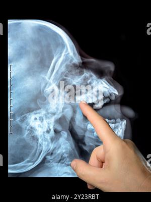Röntgenbild eines Schädels der Person. Röntgenaufnahmen renkale Kieferluxation gebrochene Knochen Nasopharynx hochwertige Handfinger-Punkte Stockfoto