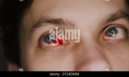 Menschliche Augen mit Blut nah oben, die einen medizinischen Zustand oder eine Verletzung darstellen. Detaillierte Ansicht betont Schweregrad und gesundheitliche Auswirkungen, geeignet für Gesundheits- und medizinische Themen. Stockfoto