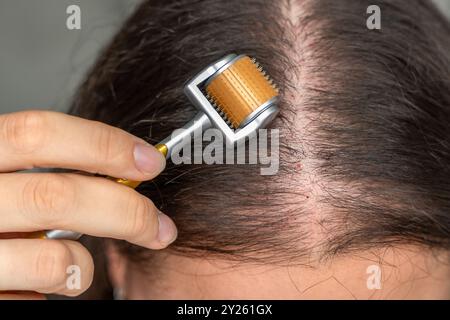 Nahaufnahme einer jungen Frau mit Mikronadelderma-Roller am Kopf zur Stimulierung des Haarwuchses zu Hause. Behandlung der gesunden Kopfhaut. Stockfoto