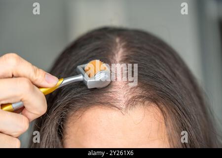 Nahaufnahme einer jungen Frau mit Mikronadelderma-Roller am Kopf zur Stimulierung des Haarwuchses zu Hause. Behandlung der gesunden Kopfhaut. Stockfoto