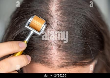 Nahaufnahme einer jungen Frau mit Mikronadelderma-Roller am Kopf zur Stimulierung des Haarwuchses zu Hause. Behandlung der gesunden Kopfhaut. Stockfoto