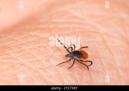 Parasitäre Insektenmilben Rizinusbohnen, Schwarzbeinige oder Hirsche zecken auf der menschlichen Haut. Ixodes. Lyme-Borreliose oder Zeckenenzephalitis Übertragungsgefahr. Stockfoto