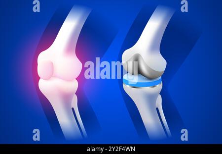 Knieimplantat, Röntgenaufnahme des Beines, 3D-Visualisierung. Vektor Stock Vektor