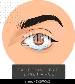 Exzessive klebrige Entladung aus menschlichem Auge – Illustration als EPS 10-Datei Stock Vektor