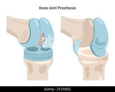 Gelenkimplantation. Verletztes oder abgelenktes menschliches Gelenk ersetzt durch künstliche Prothesen aus Titan. Osteoporose- und Arthrosebehandlungschirurgie. Illustration des flachen Vektors Stock Vektor
