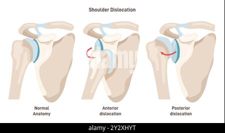 Schulterluxationstypen. Armverletzung, Oberarmknochen springt aus der schalenförmigen Fassung des Schulterblatts. Die Glenohumeralgelenksluxation. Illustration des flachen Vektors Stock Vektor