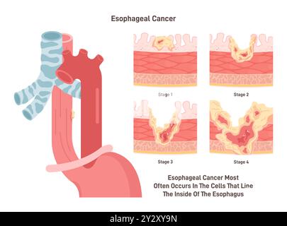 Osophaguskarzinom. Maligne Entzündung der Osophaguswandzellen. Gewebe des Osophaguskarzinoms. Gefährliche Wirkung des Zigarettenrauchens. Illustration des flachen Vektors Stock Vektor