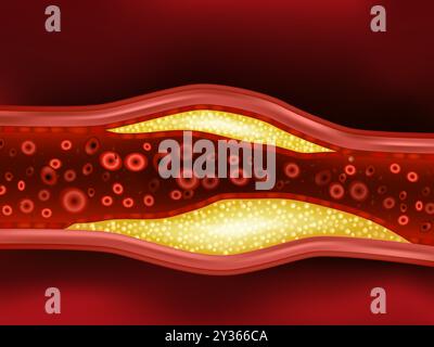 Cholesterinplaque in der Arteria. Atherosklerose. Stock Vektor