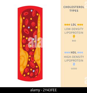 Cholesterinplaquebildung bei blockiertem Arteriendiagramm Stock Vektor