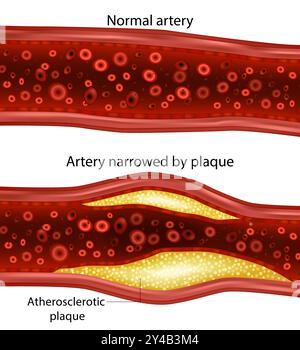 Cholesterinplaque in der Arteria. Durch Plaque verengte Arteria und normale Arteria. Atherosklerotische Plaque. Stock Vektor