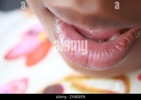 Nahaufnahme der trockenen Lippe eines Kindes Stockfoto