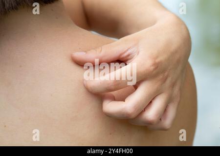 Frau kratzt ihren juckenden Rücken mit der Hand, Konzept der Allergie, Hautkrankheit Stockfoto