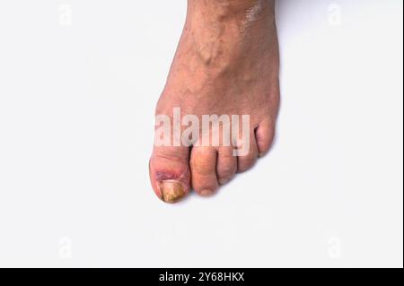 Nagelinfektion. Nagelpilzläsion Stockfoto