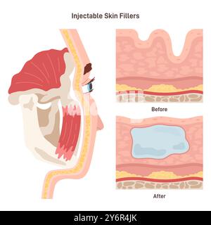 Injizierbarer kosmetischer Füllstoff. Gesichtskorrektur oder Anti-Aging-Schönheitsverfahren. Vergleich vor und nach der Behandlung. Illustration des flachen Vektors Stock Vektor