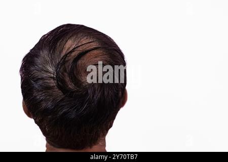 Rückansicht eines männlichen Kopfes mit Haarausfall auf weißem Hintergrund. Haarausfall-Problem eines Mannhaares, Nahaufnahme. Kahlheit, Alopezie. Mann verliert Haare, Kahlheit Stockfoto