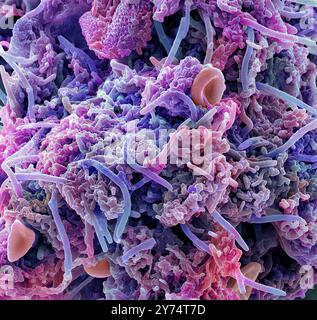 Plakette - Bakterien, Farbig Scanning Electron Micrograph (SEM). Plaque besteht aus einem Film von Bakterien in einem glykoprotein Matrix eingebettet. Die Matrix ist eine bakterielle Sekrete und Speichel gebildet. Zahnbelag ist die Hauptursache für Karies. Die Bakterien ernähren sich von Zucker in der Nahrung, die Säure als Abfallprodukt. Diese Säure greift die Zähne emailbeschichtung, was zu Karies. Die Ansammlung von Zahnbelag kann auch entzündete und infizierten Zahnfleisch führen. Schwere Zahnfleischerkrankungen können Zähne herausfallen führen. Vergrößerung: x2000 bei 10 Zentimeter gedruckt Stockfoto