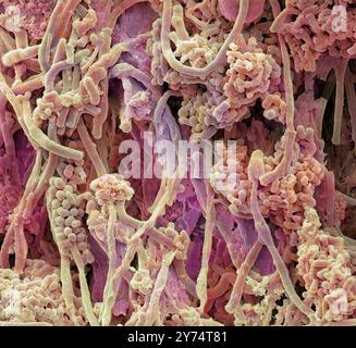 Plakette - Bakterien, Farbig Scanning Electron Micrograph (SEM). Plaque besteht aus einem Film von Bakterien in einem glykoprotein Matrix eingebettet. Die Matrix ist eine bakterielle Sekrete und Speichel gebildet. Zahnbelag ist die Hauptursache für Karies. Die Bakterien ernähren sich von Zucker in der Nahrung, die Säure als Abfallprodukt. Diese Säure greift die Zähne emailbeschichtung, was zu Karies. Die Ansammlung von Zahnbelag kann auch entzündete und infizierten Zahnfleisch führen. Schwere Zahnfleischerkrankungen können Zähne herausfallen führen. Vergrößerung: x2000 bei 10 Zentimeter gedruckt Stockfoto
