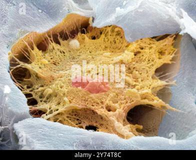 Osteozyten-Knochenzelle. Farbige Rasterelektronenmikrographie (REM) einer von Knochengewebe umgebenen Osteozytenknochenzelle. Diese gebrochene Zelle zeigt einen Kern in der Mitte. Osteozyten sind Osteoblasten (knochenbildende Zellen), die in Knochenhöhlen eingeschlossen sind (Lakunae, Depressionen im Knochen). Sie produzieren und sezernieren die organische Matrix des Knochens (Osteoid). Sobald sich Osteoid bildet, kristallisieren sich Calciumsalze darin und bilden einen harten, mineralisierten Knochen. Vergrößerung: x4000, wenn 10 Zentimeter breit gedruckt. Stockfoto