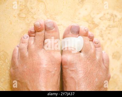 Behandlung und Prophylaxe des Hallux valgus. Silikon-Fingerabscheider. Hochwertige Fotos Stockfoto