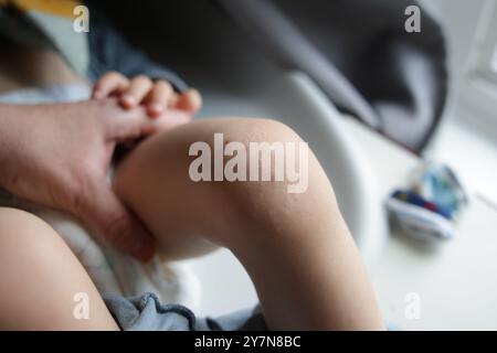 Blasenbildung bei Kniehautinfektion bei Kleinkindern. Stockfoto