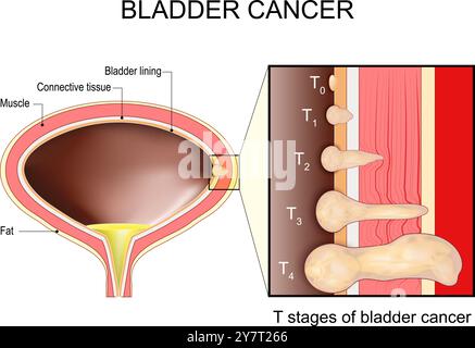 Blasenkarzinom-Stadien. Querschnitt einer menschlichen Harnblase mit Schichten wie Futter, Bindegewebe und Muskel. Nahaufnahme von Blasentumoren W Stock Vektor