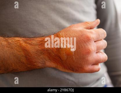 Bauarbeiter zeigt eine schwere Verbrennung zweiten Grades mit Blasen am Arm Stockfoto