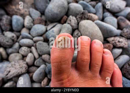 Rechter großer Zehennagel, geschwärzt durch eine Schwärzung und die engen Schuhe eines Fußwegs eines erwachsenen Mannes mit vulkanischem Stein Hintergrund Stockfoto