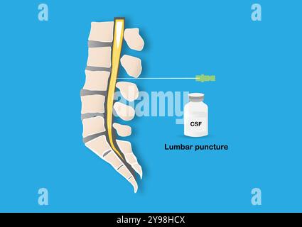 Medizinische Illustration, die eine Lumbalpunktion darstellt, zeigt eine Nadel, die in den Rückenmarkskanal gelangt, um Liquor (CSF) zu sammeln. Stock Vektor