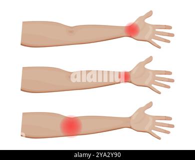 Schulter- und Ellenbogengelenk-Schmerz-Vektor-Illustration Stock Vektor