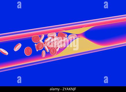 3D-Darstellung des Innern einer transparenten Glasarterie mit der Bewegung der roten Blutkörperchen. Das Fett sammelt sich an, bis es das Innere blockiert. Stockfoto