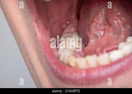 Mundhöhle des kaukasischen Mannes, weit geöffneter Mund und erhöhte Zunge, Backenzähne und Mundboden. Stockfoto