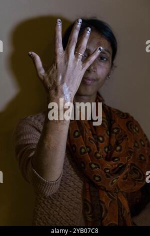 Indien, Kolkata, Frauen Opfer Säureangriff, portrait Stockfoto