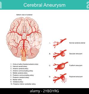 Zerebrales Aneurysma. Eine ausballige Arterie geschwächte Fläche in der Wand einer Arterie im Gehirn. Stockfoto